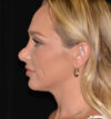 Revision Rhinoplasty case #15059