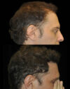 FUE Hair and Eyebrow Transplant case #15144
