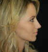 Rhinoplasty case #15297