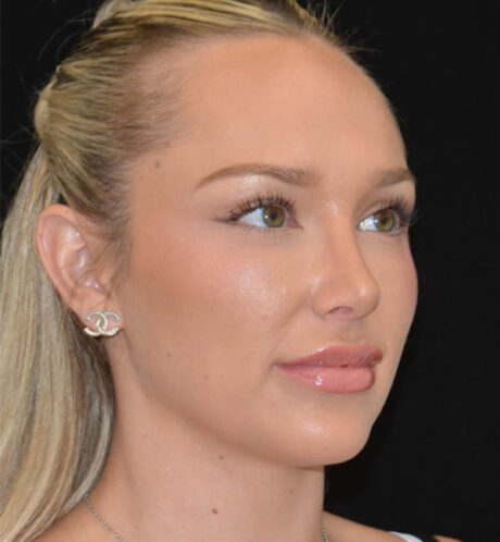 Revision Rhinoplasty case #15059