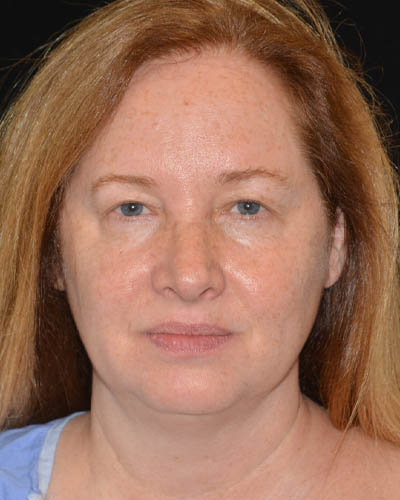 Facelift case #15039
