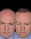 FUE Hair and Eyebrow Transplant case #15142