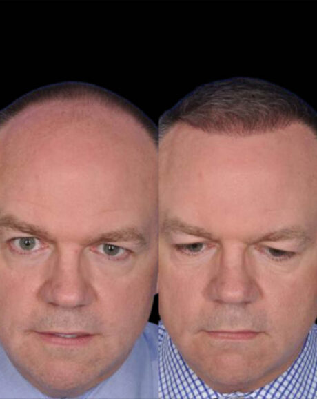 FUE Hair and Eyebrow Transplant case #15142