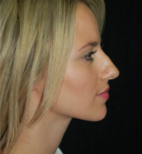 Rhinoplasty case #15297