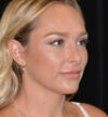 Revision Rhinoplasty case #15059