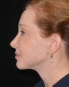 Facelift case #15039