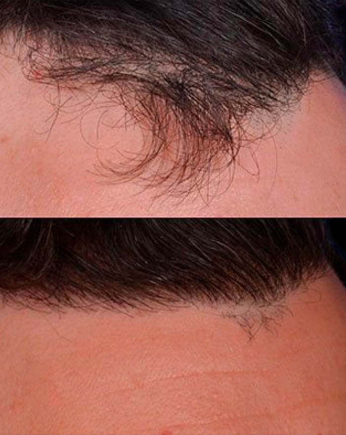 FUE Hair and Eyebrow Transplant case #15140