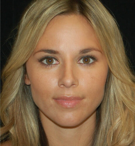 Rhinoplasty case #15290