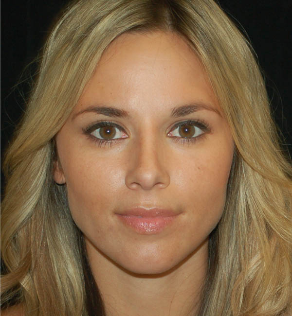 Rhinoplasty case #15290