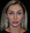 Revision Rhinoplasty case #15064