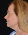 Facelift case #15039