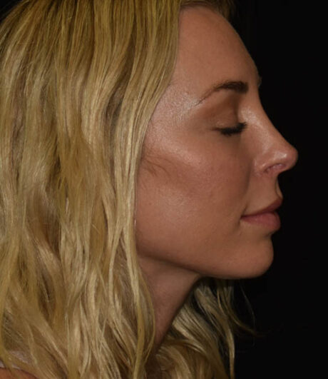 Revision Rhinoplasty case #15161