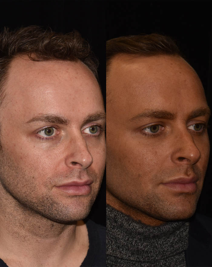 FUE Hair and Eyebrow Transplant case #15138