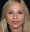 Rhinoplasty case #15290