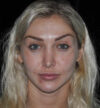 Revision Rhinoplasty case #15064