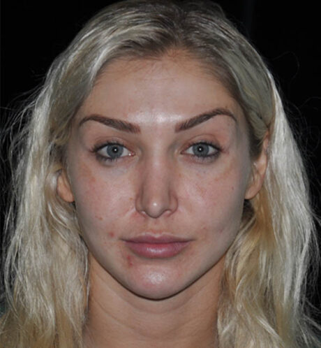 Revision Rhinoplasty case #15064