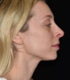 Revision Rhinoplasty case #15161