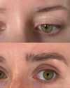FUE Hair and Eyebrow Transplant case #15136