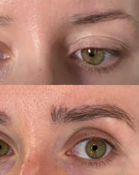 FUE Hair and Eyebrow Transplant case #15136