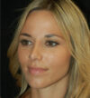 Rhinoplasty case #15290