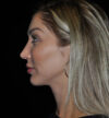 Revision Rhinoplasty case #15064