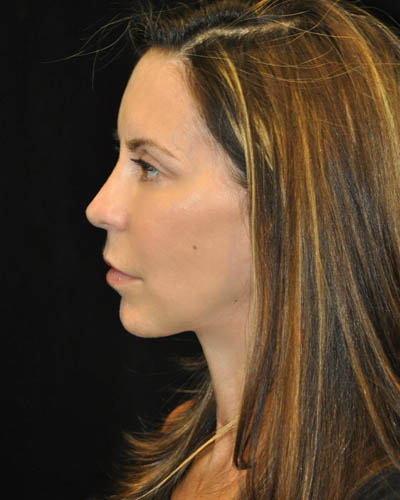 Facelift case #15000
