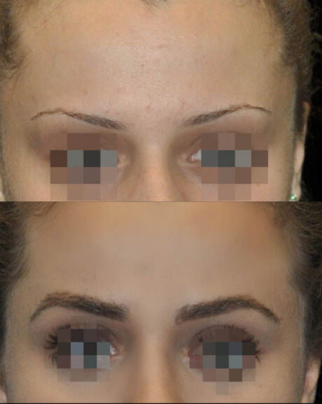 FUE Hair and Eyebrow Transplant case #15134