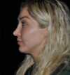 Revision Rhinoplasty case #15064