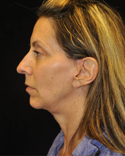 Facelift case #15000