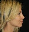 Rhinoplasty case #15290