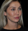 Revision Rhinoplasty case #15064
