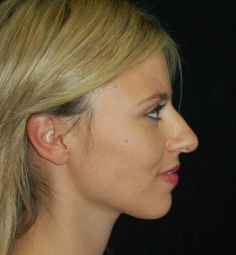 Rhinoplasty case #15290