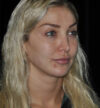 Revision Rhinoplasty case #15064