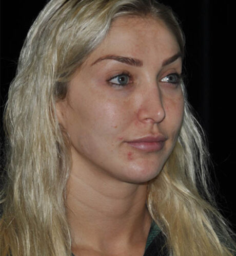 Revision Rhinoplasty case #15064