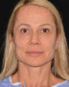 Facelift case #15028