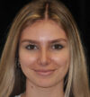 Rhinoplasty case #15283