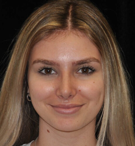 Rhinoplasty case #15283