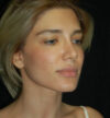 Revision Rhinoplasty case #15071