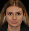 Rhinoplasty case #15283