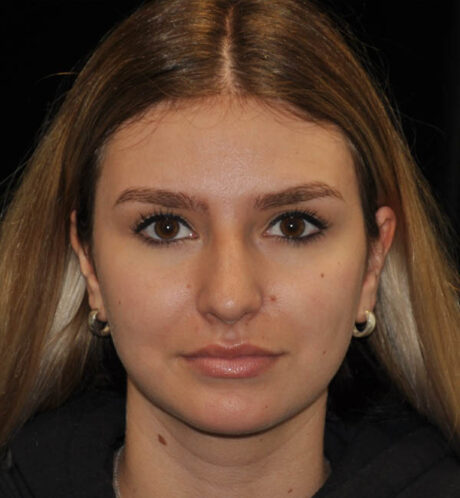 Rhinoplasty case #15283