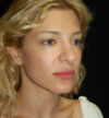 Revision Rhinoplasty case #15071