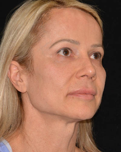 Facelift case #15028