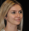 Rhinoplasty case #15283