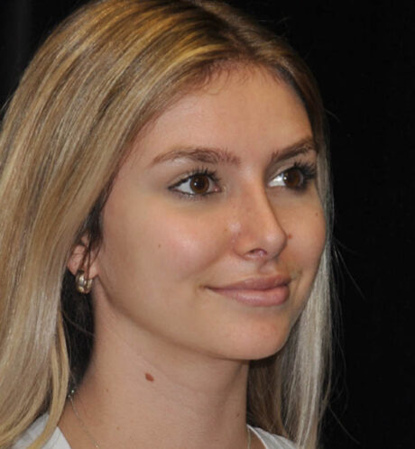 Rhinoplasty case #15283