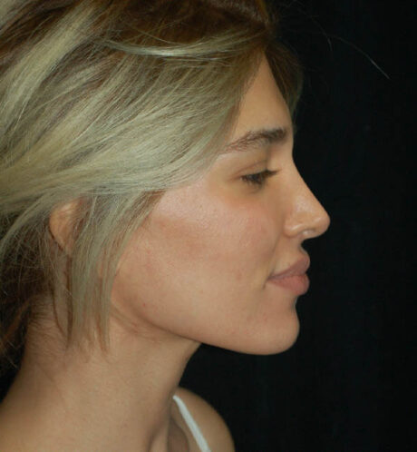 Revision Rhinoplasty case #15071
