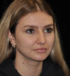 Rhinoplasty case #15283