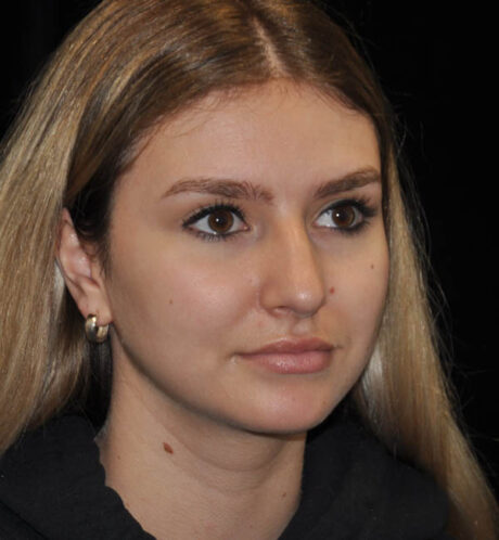 Rhinoplasty case #15283