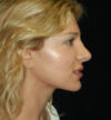 Revision Rhinoplasty case #15071