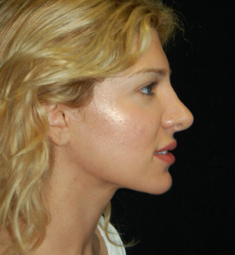 Revision Rhinoplasty case #15071
