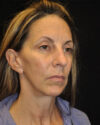 Facelift case #15000